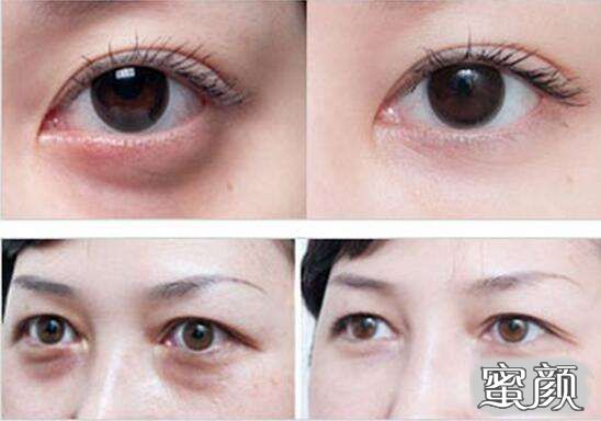 科技揭秘，最新去眼袋最佳方法，重塑眼部美麗新篇章！