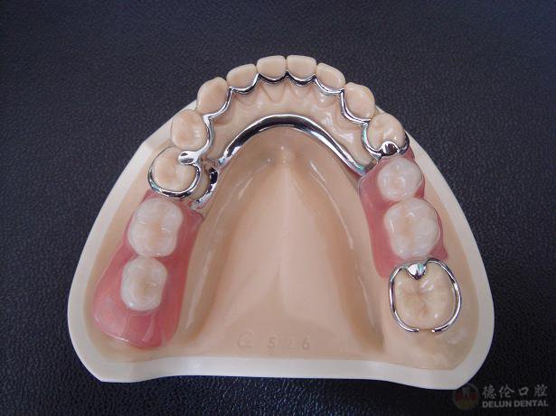 關于活動假牙價格的探討與解析