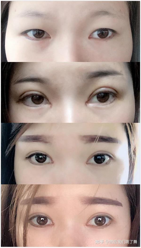 雙眼皮新技術揭秘，小明的魔法雙眼皮之旅