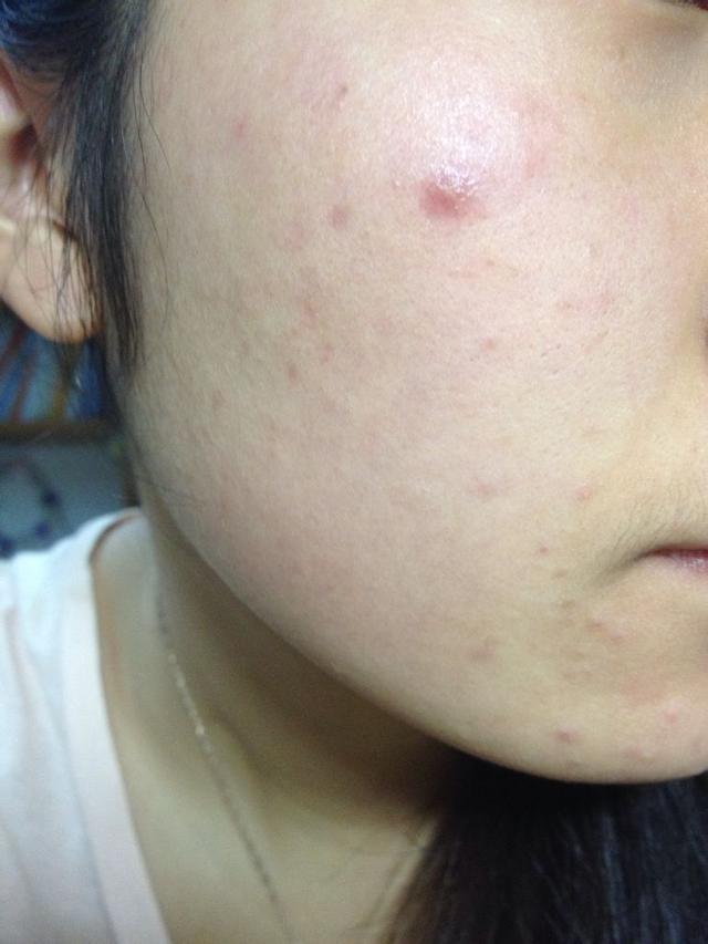 擠痘痘最新視頻,專業觀點論述與實戰操作展示