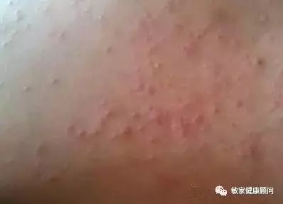 失禁性皮炎最新分期,智能照護(hù)助力重塑生活品質(zhì)